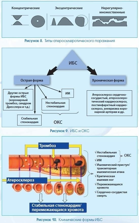 Патофизиология диастолической дисфункции в контексте ишемической болезни сердца
