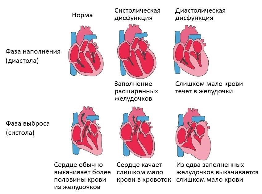 Трудности диагностики диастолической дисфункции при хронической сердечной недостаточности
