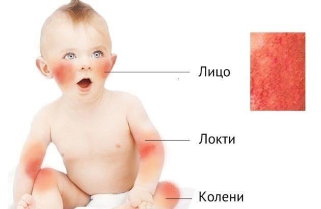 Что делать, если у ребенка аллергия и его призывают на службуЕсли у ребенка диагностирована аллергия и его призывают на службу, первым делом необходимо проконсультироваться с врачами, которые могут подтвердить диагноз и определить степень тяжести состояния. Состояние должно быть тщательно оценено, поскольку оно повлияет на классификацию годности к службе. Подтвержденный диагноз должен быть подтвержден медицинским свидетельством, подтверждающим наличие аллергии и ее потенциальное влияние на способность к службе.