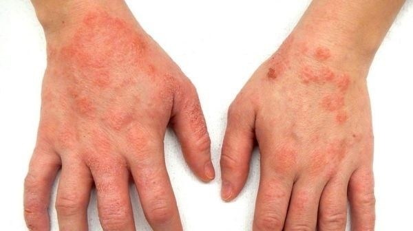 С какой степенью экземы в армию не берут?