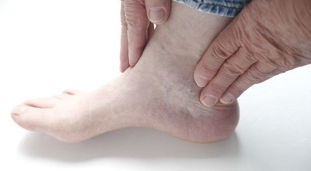 Как распознать артроз таранно-ладьевидного сустава на ранней стадии?