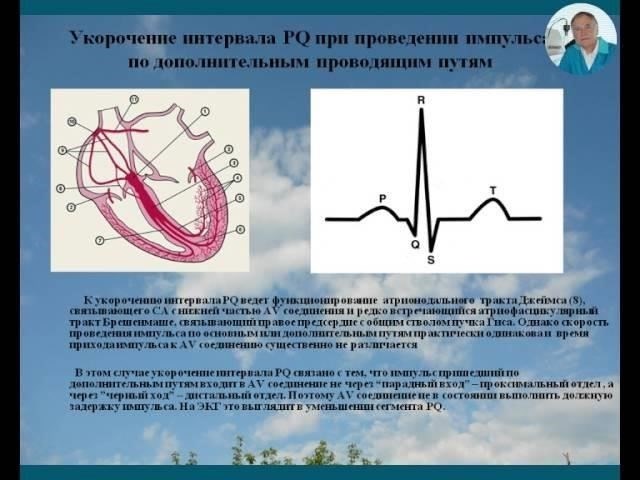 Если результаты показывают, что укороченный интервал PQ не указывает на значительный риск развития дальнейших проблем с сердцем, человек все равно может быть допущен к службе. Однако тем, у кого есть сопутствующие заболевания сердца или другие осложняющие факторы, может быть рекомендовано отказаться от военной службы. Упрощенный подход к оценке таких случаев отражает тенденцию к модернизации практики призыва, когда во главу угла ставится функциональное здоровье, а не традиционная, жесткая система.