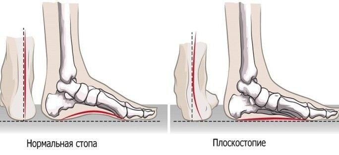 Профилактика плоскостопия: как избежать заболевания