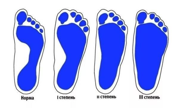 Как определить плоскостопие: признаки и симптомы