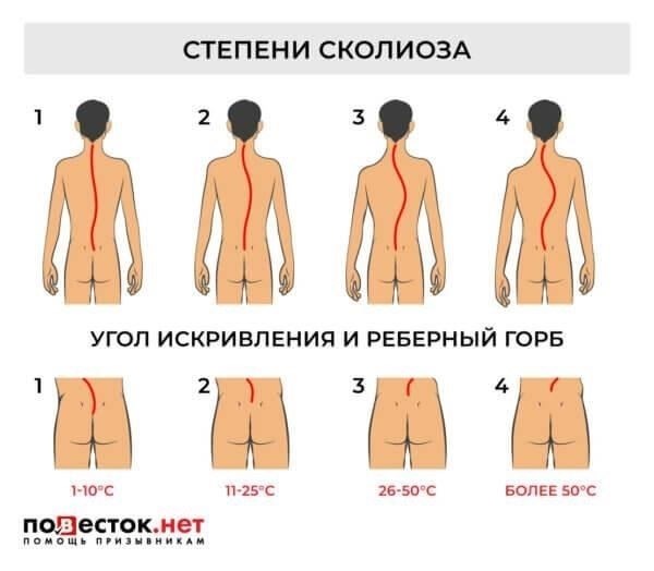 Критерии приемлемости для службы со сколиозом