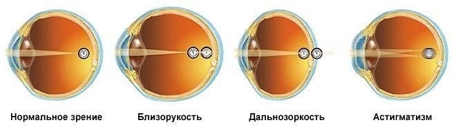 Любое состояние глаз, например значительные аномалии рефракции или такие заболевания, как глаукома, должно быть оценено офтальмологом, чтобы определить право на участие в программе.