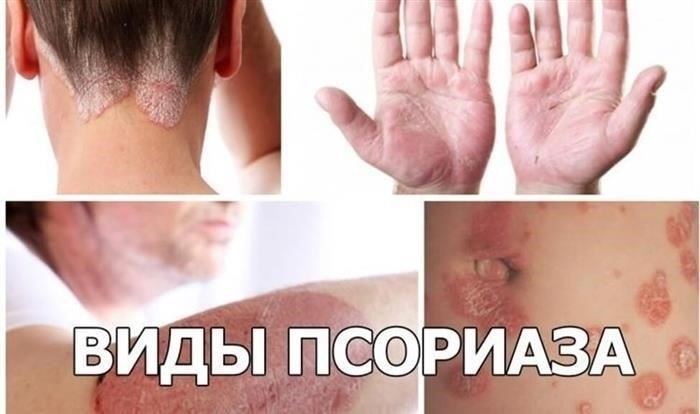 Как тяжесть псориаза влияет на пригодность к военной службе
