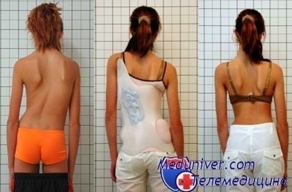 Как военкомат определяет степень ограничения годности из-за искривления позвоночника?