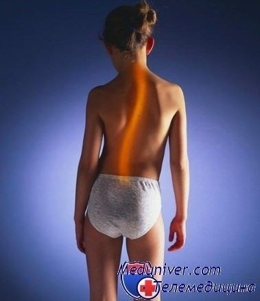 Какие медицинские заключения требуются для признания сколиоза причиной негодности к службе?