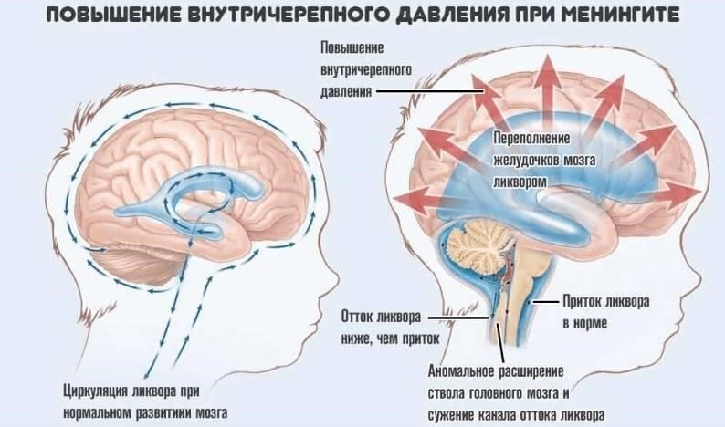 Трудности диагностики гипертонии в условиях повышенного стресса в армии