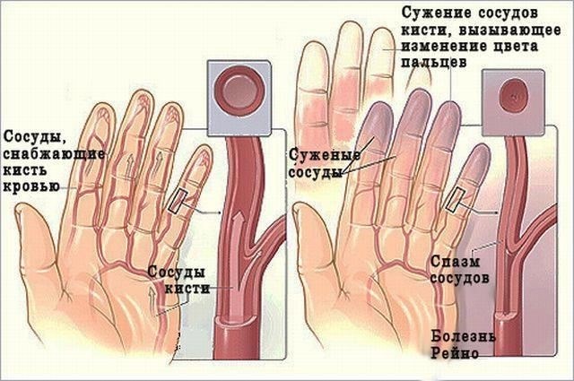 У людей с синдромом Рейно симптомы обычно носят временный характер, но при отсутствии должного лечения могут привести к долгосрочным последствиям. Диагноз заболевания часто ставится на основании клинических признаков и иногда подтверждается специальными тестами. Оно также может быть связано с другими аутоиммунными заболеваниями.